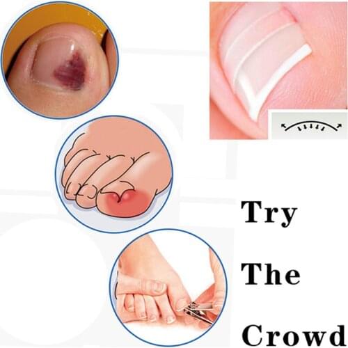 100pcs/box Ingrown Pedicure Toenail Straightening Clip Toe Nail Sticker Tools Practical Operation Simple Conveninently