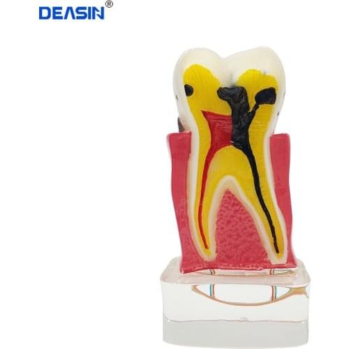 Dental Study Yellow Teaching Tooth Model 4 times Teeth Disease Model