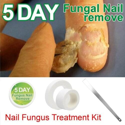 5 DAY Toe Nail Fungus Treatment Anti Fungal Nail Infection Essence Nail Treatment Removal Nail Care Lotion Chinese Medicine Hers