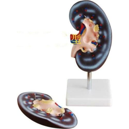 2X Enlarged Renal Anatomy Model The Anatomical Model of Human Kidney Amplification of The Kidney Model Medical Teaching Supplies