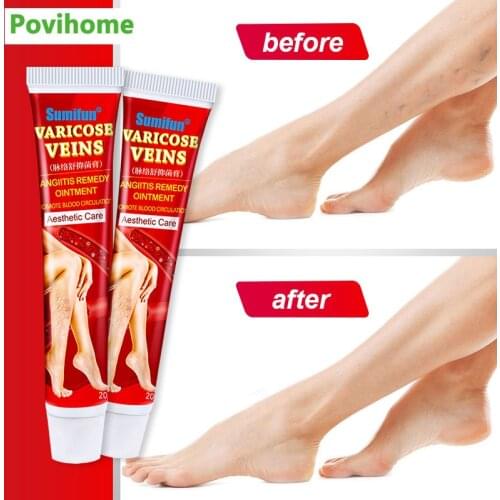 Chinese Herbal Medical Varicose Vein Treatment Cream Ointment Phlebitis Spider Veins Removal Cream Angiitis Removal K10011