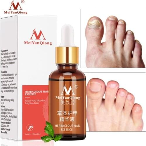 MeiYanQiong Fungal Nail Repair Serum Treatment Foot Nail Fungu Removal Essence Anti Infection Paronychia Onychomycosis Nail Care