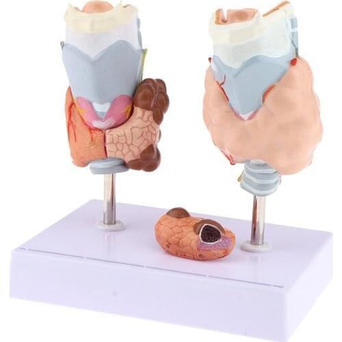 Human Anatomical Thyroid Gland Pathology Anatomy Medical Teaching Model - Lab Supplies Science Classroom Education