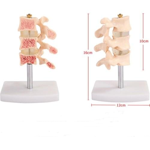 Human Lumbar Lesion Medical Model Vertebrae Spine Osteoporosis Anatomical Skeleton Model BIX-A1022