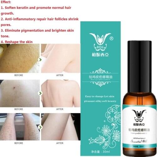 30ML New Chicken Skin Folliculitis Treatment Exfoliating Shrink Pores Keratosis Pilar Remover Essential Oil