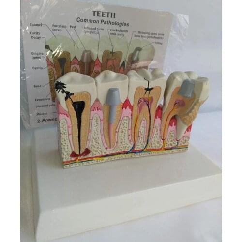 Dental Model Tooth Common Pathologies Anatomy Model Medicine Teaching Demonstration，Dentist Office Educational Tool
