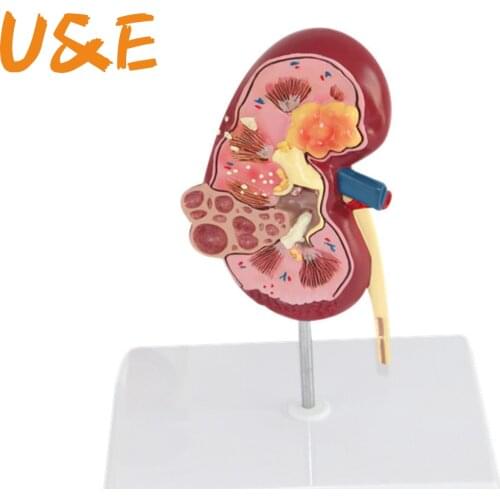 Organ Medical Kidney Anatomical Model Lesion Kidney Model Human Anatomy Teaching Supplies