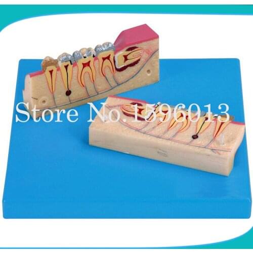Dissected Model of Teeth Tissue,Teeth tissue decomposition model,Teeth Organizational Model