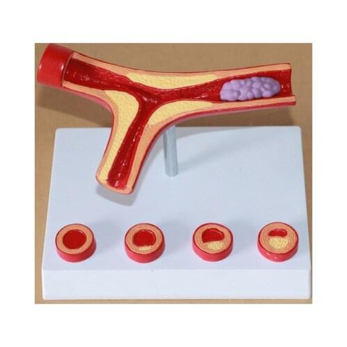 Human body offshoot atherosclerosis Cardiovascular artery Hardening model Artery Medical Teaching free shipping