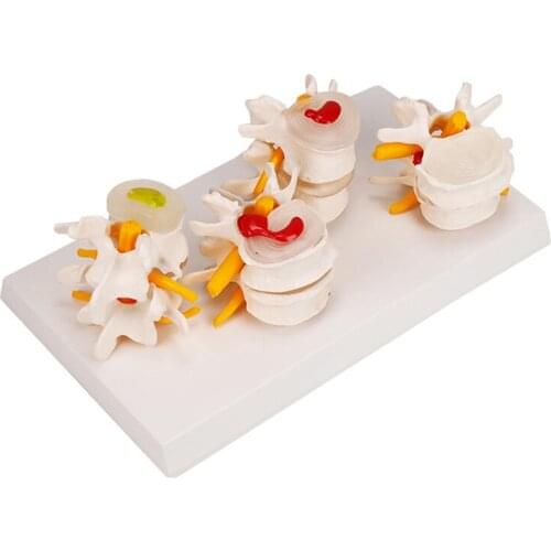 4-Stages Lumbar Vertebrae Lesion Model Human Anatomy Skeleton Spine BIX-A3572