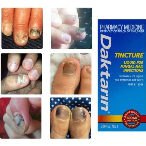 Australia Thursday Tea Tree Oil AntiFungal Nail Treatment Solution for Candida Skin Infection Athletes foot Ringworm Jock itch