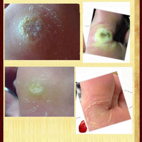 Chinese Medicine Treatment Foot Corn Removal Plantar Warts Pomada De Verruga Foot Care Medical Plaster Ointment Warts Removal