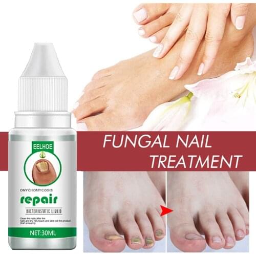 EELHOE Nail Fungus Treat Onychomycosis Toe Treat Feet Care Nail Repair Anti Infections Paronychia Onychomycosis Nails Care