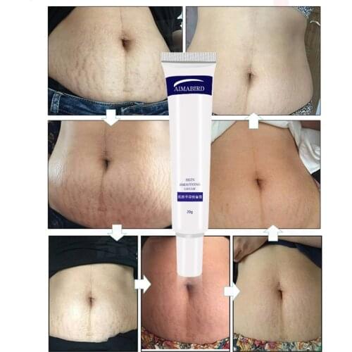 Smooth Skin Cream Fat wrinkles Pregnancy Removal To Maternity Skin Repair Body Cream Soft Skin Stretch Mark Scar Removal Creams