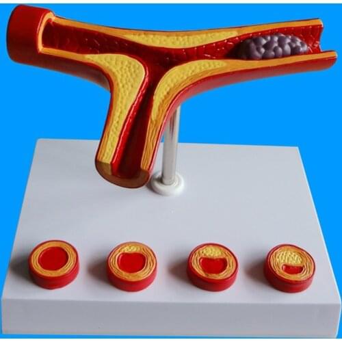 Human Vessel Anatomical Model Atherosclerosis Model for Medical Training Model