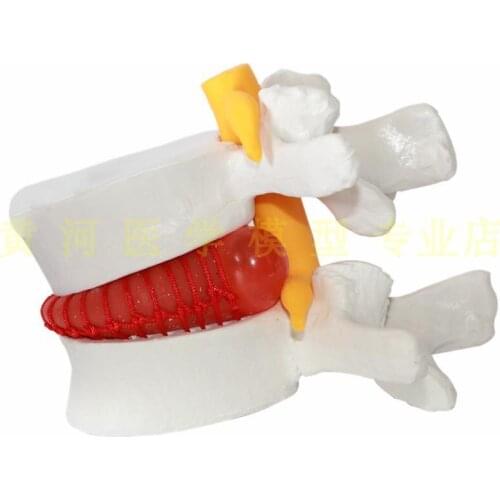 Human lumbar intervertebral disc demonstration model Lumbar spine model Spinal model Spinal Joint model
