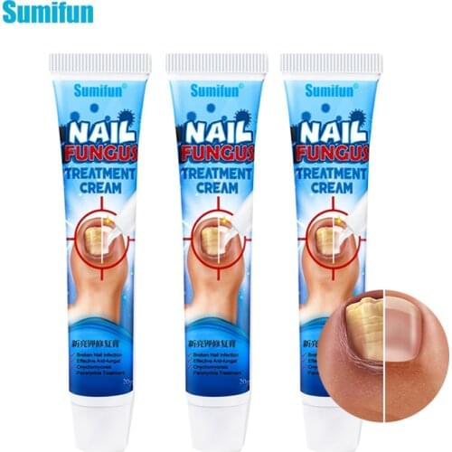 3Pcs Nail Fungus Cream Onychomycosis Removal Fungal Nail Treatment Paronychia Antibacterial Feet Toe Nail Care Ointment