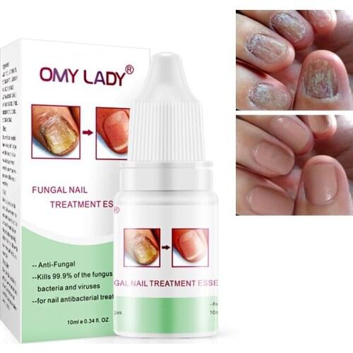Hot Sell Nail Repair Liquid Against Nail Onychomycosis Removal Serum Nail Care Treatments New