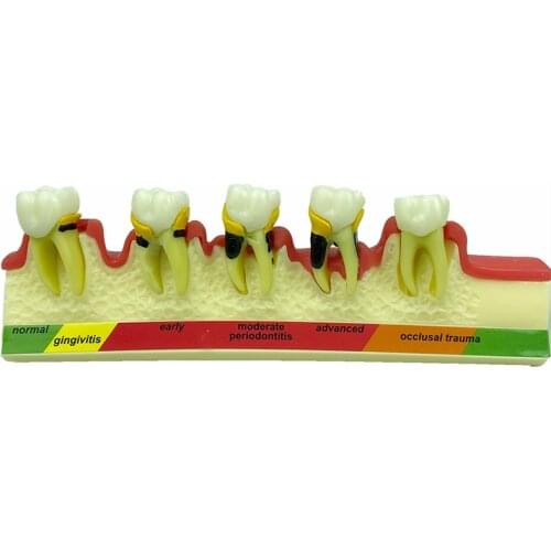 Dental 5-Stage Periodontal Disease Dentoform Typodont Dental Teaching Model Patient Communication Model