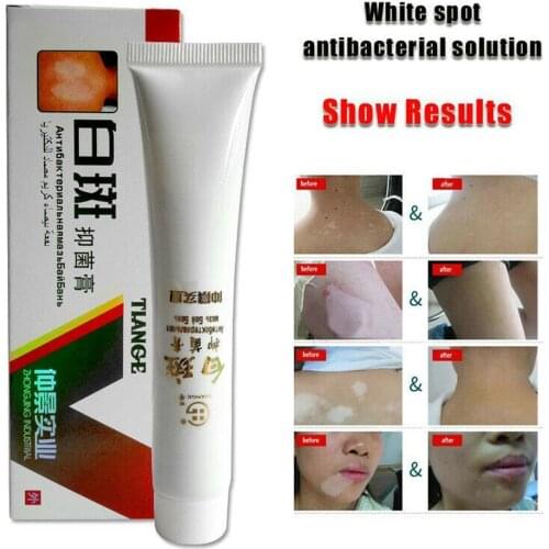 30g Medical White Spot Disease Cream Pigment Melanin Promoting Liniment Skin Care Vitiligo Leukoplakia Disease Treatment Plaster