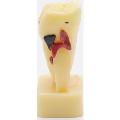 Dentistry Lab Equipment Study Teach Tooth Model Teeth Disease Model