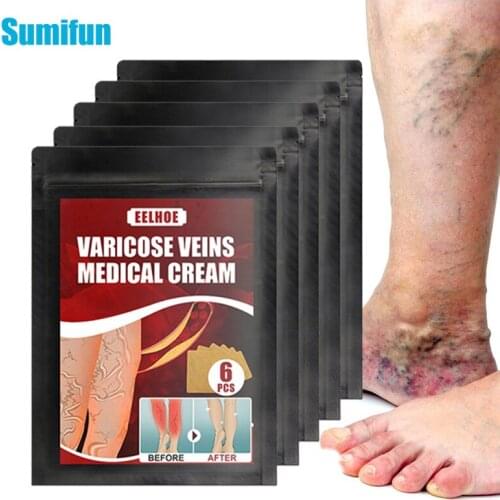 6Pcs Spider Leg Veins Varicose Treatment Plaster Varicose Veins Cure Patch Vasculitis Angiitis Phlebitis Natural Herbal Patches
