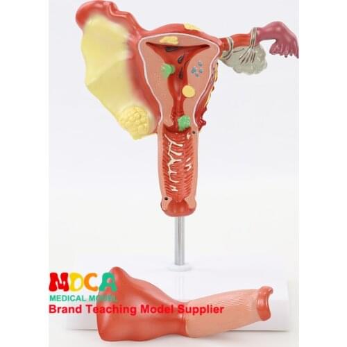 MSZXT004 Medical Teaching of Pathological Reproduction and Family Planning of Human Uterine and Ovary and Anatomical Model