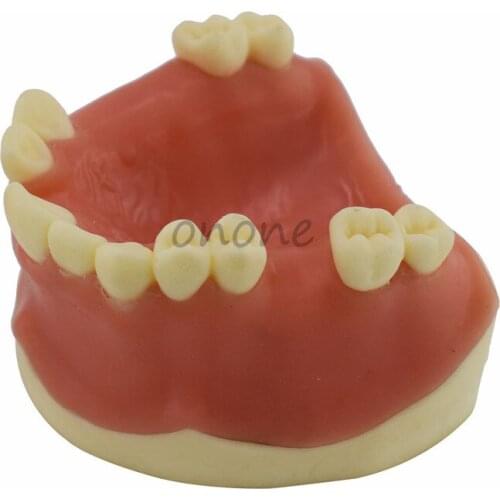 1pcs Maxillary Missing Tooth Model Bone Imitating Oral Teaching Aids Dental Implant Placement Exercise Prop