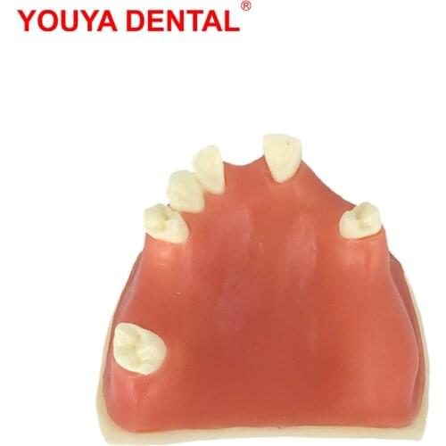 Tooth Implant Model For Dentist Student Studying Training Practice Dental Model Teeth Teaching Models Medical Dentistry Products