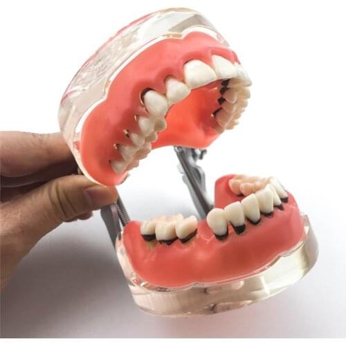 Dental Typodont Teeth Model Adult Pathological Periodontal disease 4017# tools