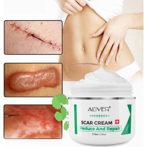 Acne Scar Removal Cream Pimples Stretch Marks Face Gel Remove Acne Smoothing Whitening Moisturizing Body burn cream Skin Care