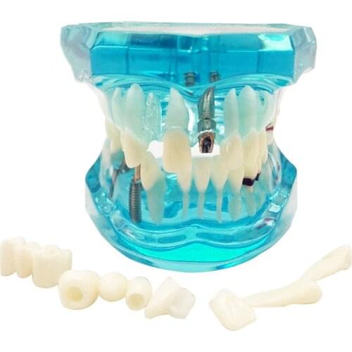 Dental Restoration Teeth Model Dental Implant Disease Teeth Model with Bridge Detachable Dental Disease Teaching Study Model