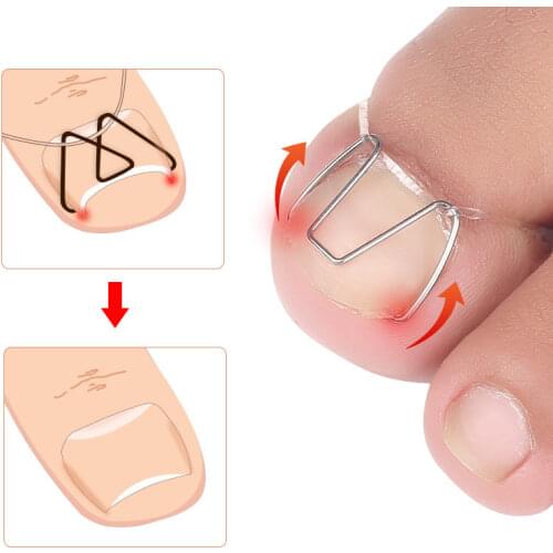 Stainless Ingrown Foot Care Tool Toe Nail Fixer Pedicure Recover Embed Toenail Correction Lifter Tool Kit Inset Buckle