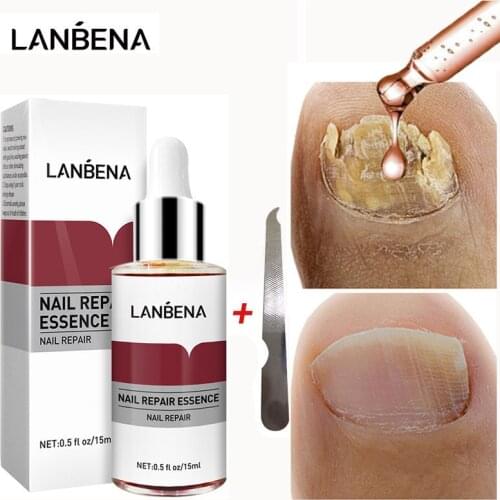 LANBENA Fungal Nail Repair Essence Serum Onychomycosis Treatment Nail Fungus Removal Gel Anti Infection Paronychia