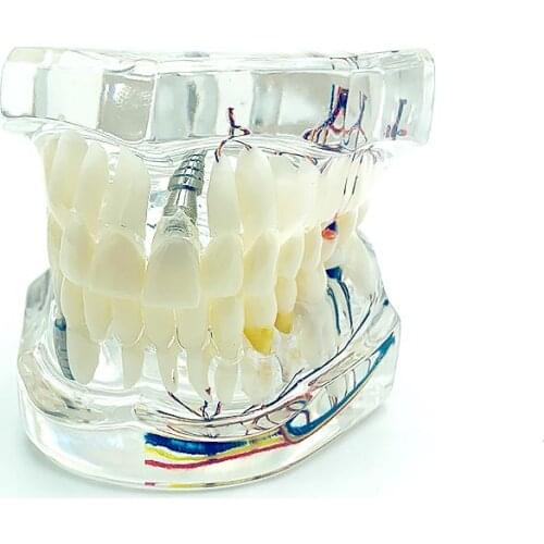Pathologies Repair Model with Nerve Dental Teeth Model Demonstration Model
