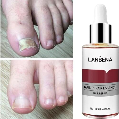LANBENA Fungal Nail Repair Essence Serum Anti Infection Paronychia Onychomycosis Treatment Care Foot Nail Fungus Removal Gel