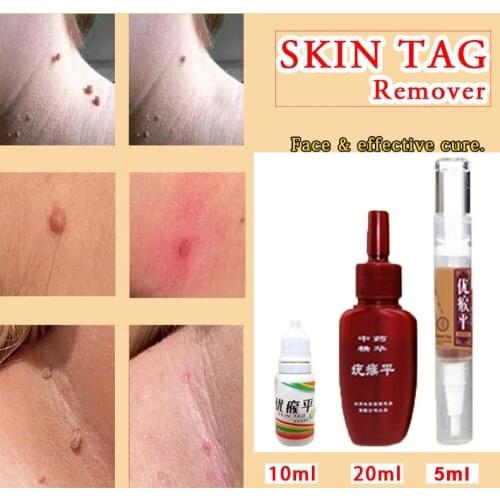 Skin Tag Remover 12 hours Medical fast Removal Mole & Genital Wart Foot Corn Treatment Kit skin Care Anti Wart Bacteriostatic