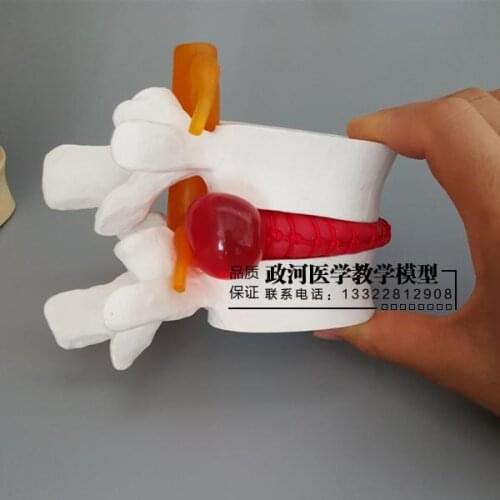 Medical human lumbar disc disease presentation model Orthopedic spine model