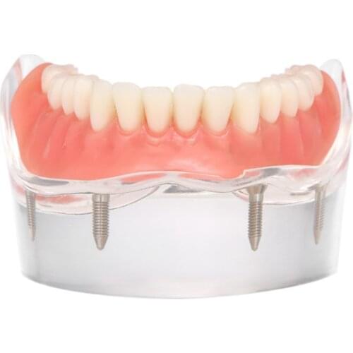 Dental Implant Teeth Model Removable Interior Mandibular Lower Jaw Teeth Model with 4 Implant screw Teaching Study Repair Model