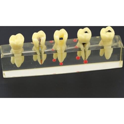 Dental Study Teach Teeth Model Endodontic Treatment Demonstration Model 4012