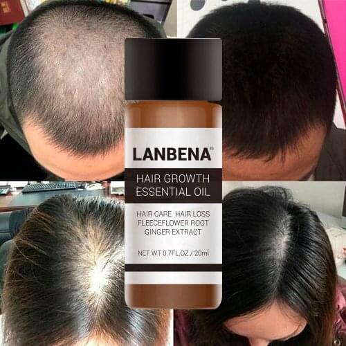 Andrea Growth Essence Loss Liquid Dense 1 Bottle Essential Oil Liquid Treatment Preventing Hair Loss Hair Care Andrea 20ml
