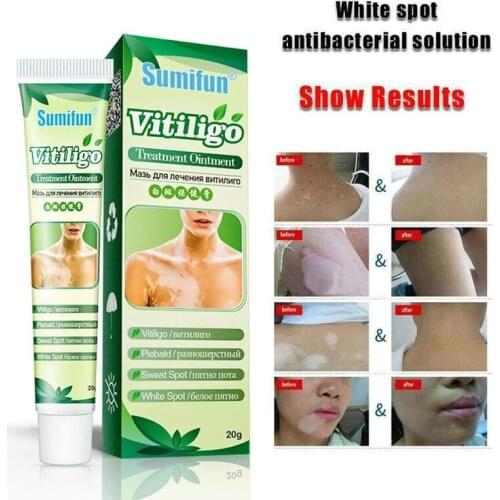 White Spot Disease Treatment Ointment Leukoplakia Disease Spot Pigment Sweat Repair Cream Melanin Skin Cream Care Vitiligo E3A9