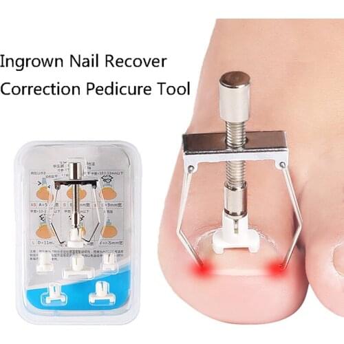 Ingrown Nail Recover Correction Pedicure Toenail Fixer Ingrown Foot Nail Care Tool Orthotic Toenail Correction Pedicure Tool