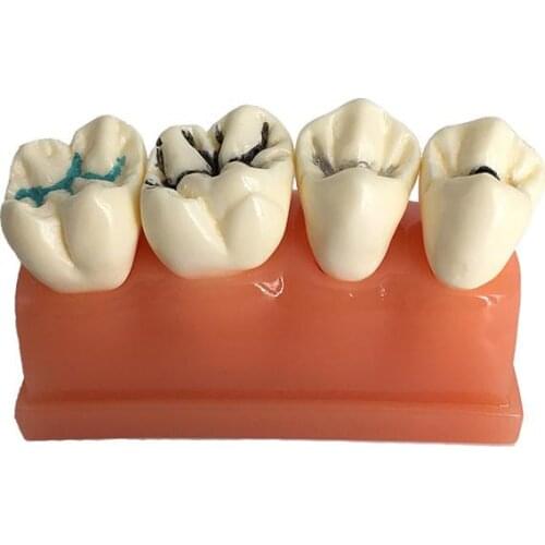 1Pc Dental Pit and Fissure Sealing Treatment Teeth Tooth Study Learn Model For Dental Lab