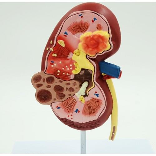 Anatomical model of internal organs of medical human kidney structural diseases