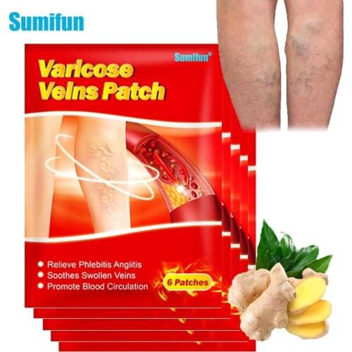 30pcs Sumifun Varicose Veins Plaster Vasculitis Phlebitis Spider Cream Varicosity Angiitis Removal Herbal Medical Plaster K06201