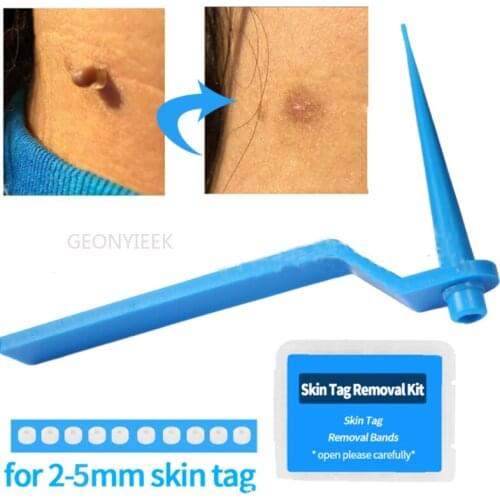Swabs Adult Mole Wart Face Care1set Skin Tag Kill Skin Mole Wart Remover Micro Skin Tag Removal Kit With Cleansing