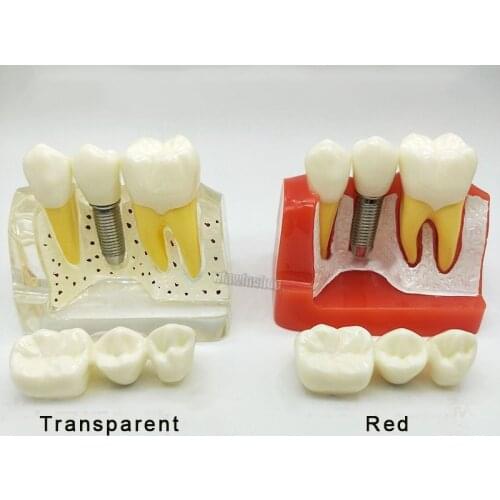 1Pc Dental Removable Model Teach Implant Crown Bridge Dental Demonstration Teeth Model