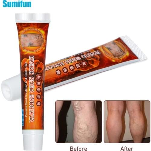 5pcs New Varicose Veins Treatment Cream 100% Original Vasculitis Phlebitis Spider Pain Relief Ointment Medical Plaster skin care