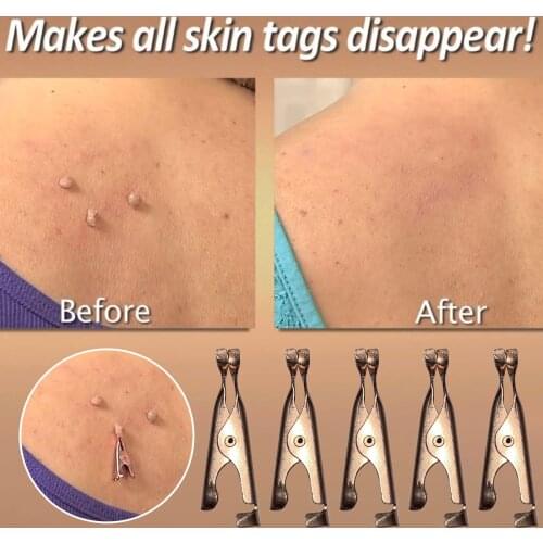 10PC Skin Tags Remover Small Clip Wart Remover Coppers Tags Out Remover Skin Wart Tags Tattoo Clippers Beauty Removal Tools